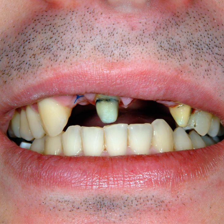 antes implante dental clinica arcos almeria