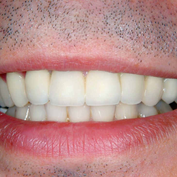 implante dental antes y despues clinica arcos almeria